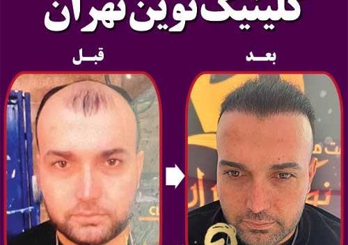 عکس قبل کاشت مو علی قلی زاده