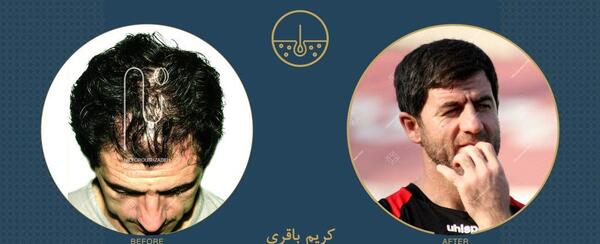 عکس قبل کاشت مو علی قلی زاده