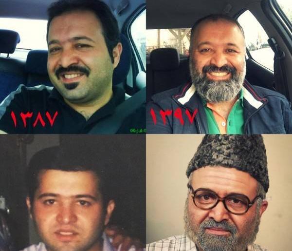 عکس قبل کاشت مو علی قلی زاده