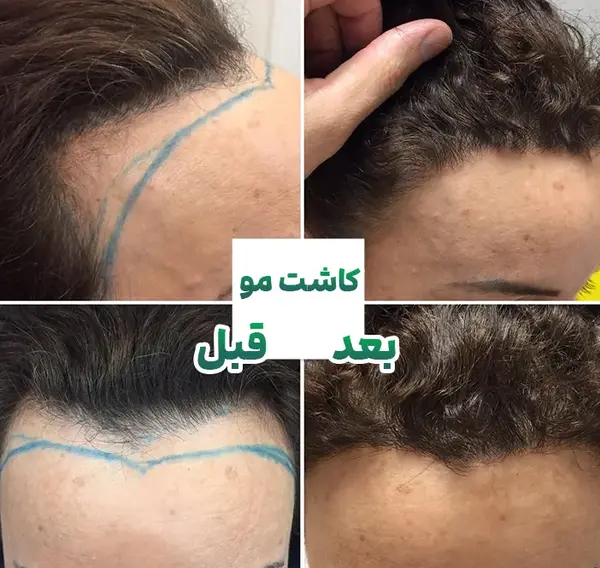 عکس قبل و بعد کاشت مو