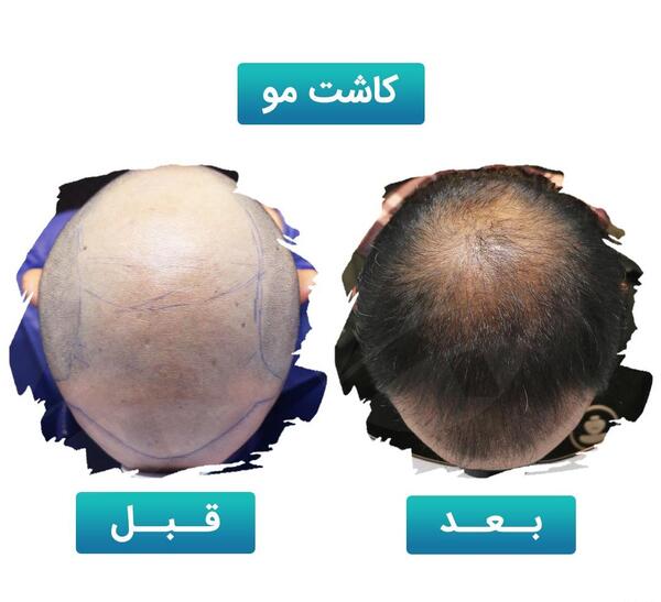 عکس قبل و بعد کاشت مو