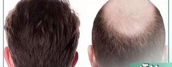 عکس قبل و بعد کاشت مو