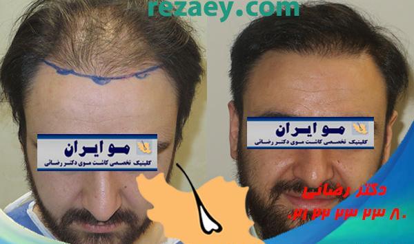 عکس قبل و بعد کاشت مو