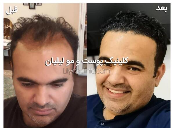 عکس قبل و بعد کاشت مو