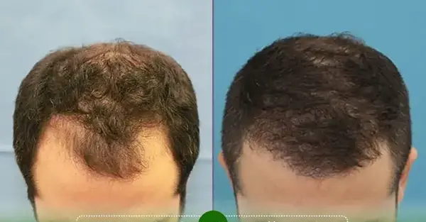 عکس قبل و بعد کاشت مو