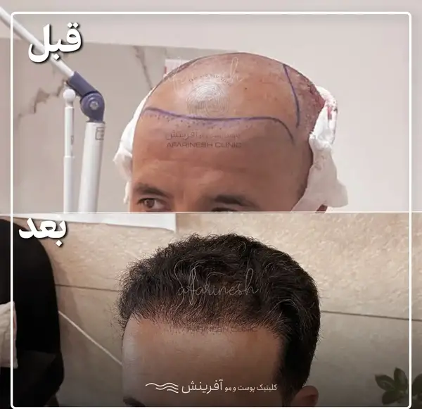 عکس قبل و بعد کاشت مو