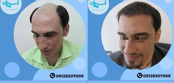 عکس قبل و بعد کاشت مو