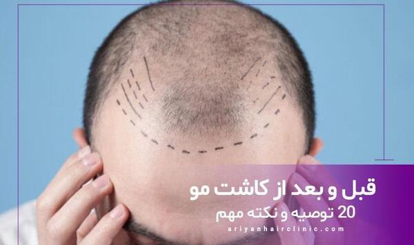عکس قبل و بعد کاشت مو زنان