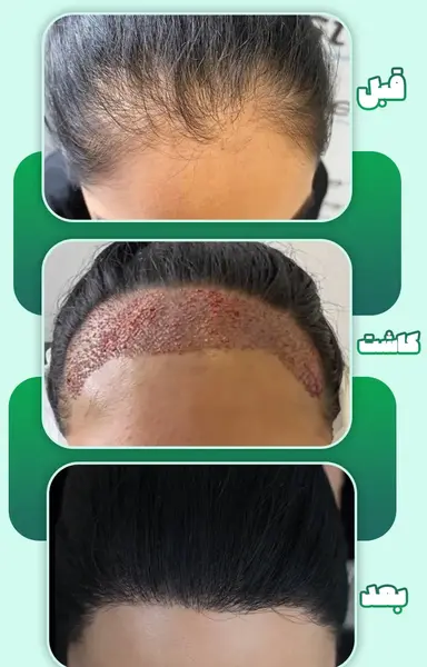 عکس قبل و بعد کاشت مو زنان
