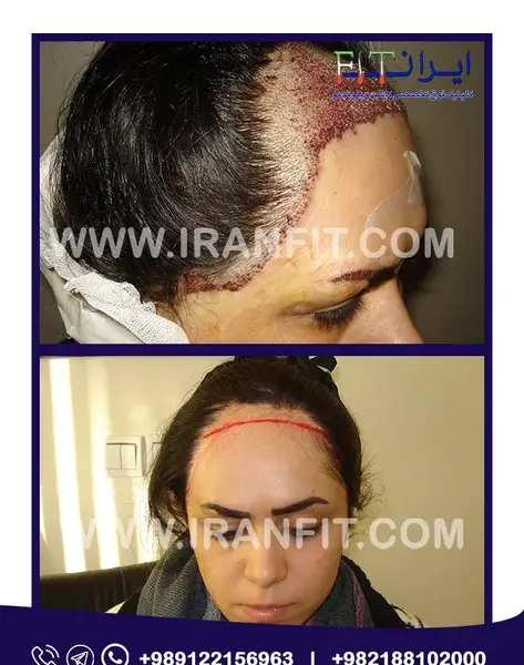 عکس قبل و بعد کاشت مو زنان