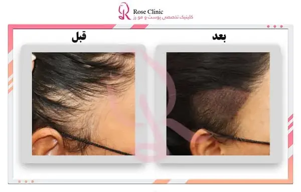 عکس قبل و بعد کاشت مو زنان