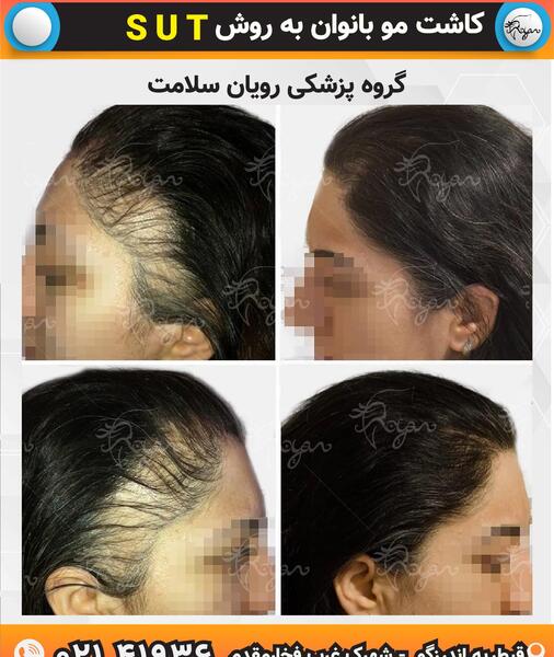 عکس قبل و بعد کاشت مو زنان