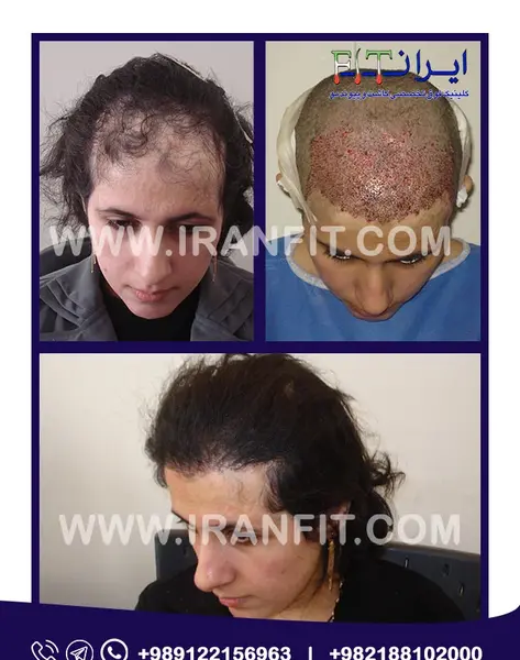 عکس قبل و بعد کاشت مو زنان