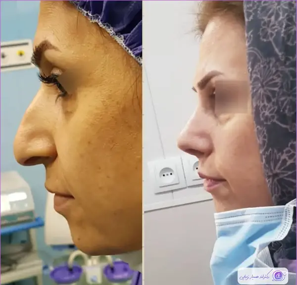 عکس قبل و بعد عمل بینی محسن یگانه