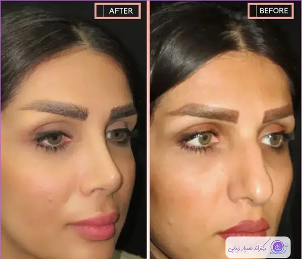 عکس قبل و بعد عمل بینی محسن یگانه