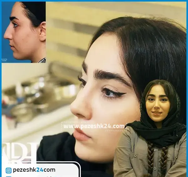 عکس قبل و بعد عمل بینی محسن یگانه