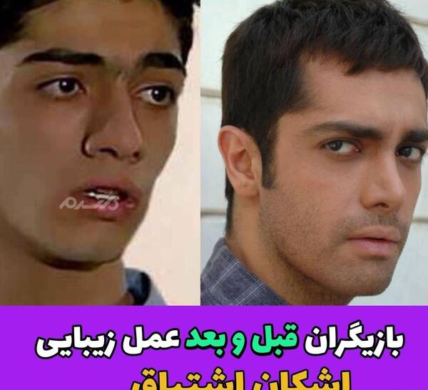 عکس قبل و بعد عمل بینی محسن یگانه