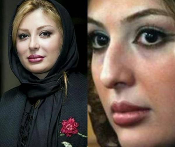 عکس قبل و بعد عمل بینی محسن یگانه