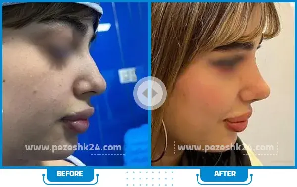 عکس قبل و بعد عمل بینی محسن یگانه