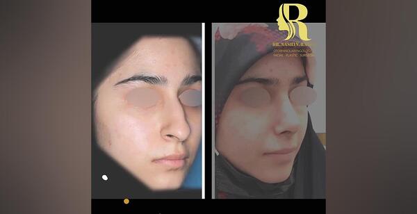 عکس قبل و بعد عمل بینی شاهرخ استخری