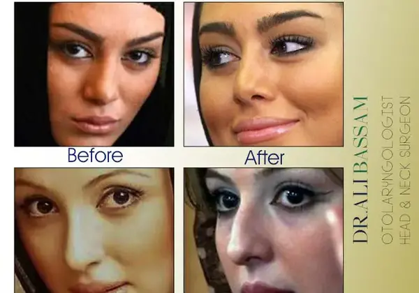عکس قبل و بعد عمل بینی شاهرخ استخری