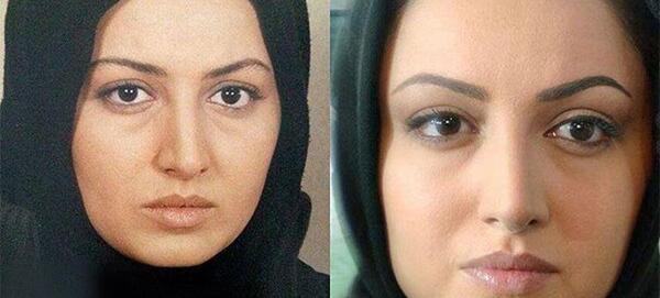 عکس قبل و بعد عمل بینی شاهرخ استخری
