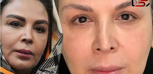 عکس قبل و بعد عمل بینی شاهرخ استخری