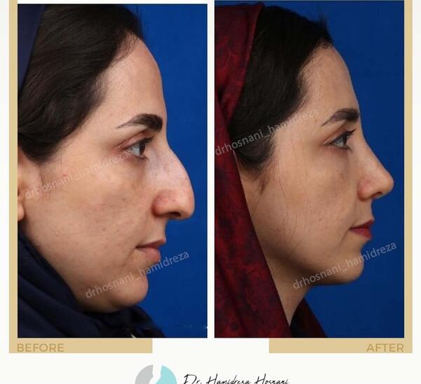 عکس قبل و بعد عمل بینی مردانه