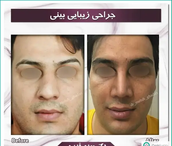 عکس قبل و بعد عمل بینی مردانه