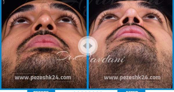 عکس قبل و بعد عمل بینی مردانه