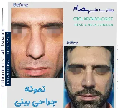 عکس قبل و بعد عمل بینی مردانه