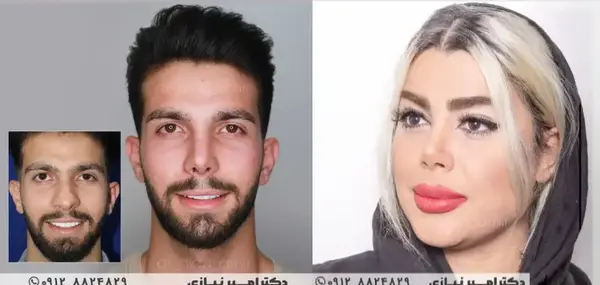 عکس قبل و بعد عمل بینی مردانه