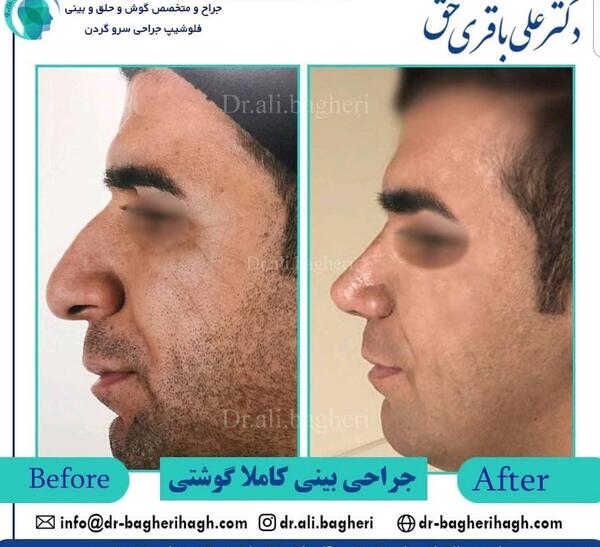 عکس قبل و بعد عمل بینی مردانه