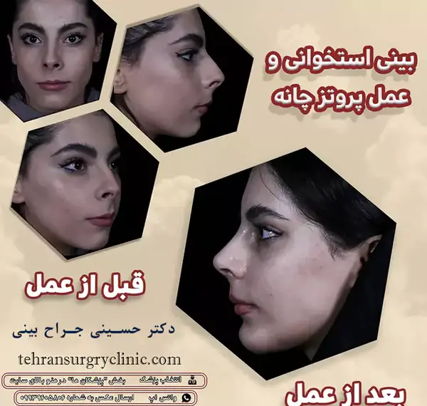 عکس قبل و بعد عمل بینی مردانه