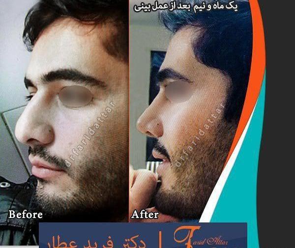 عکس قبل و بعد عمل بینی مردانه