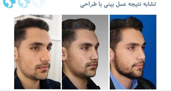 عکس قبل و بعد عمل بینی مردانه