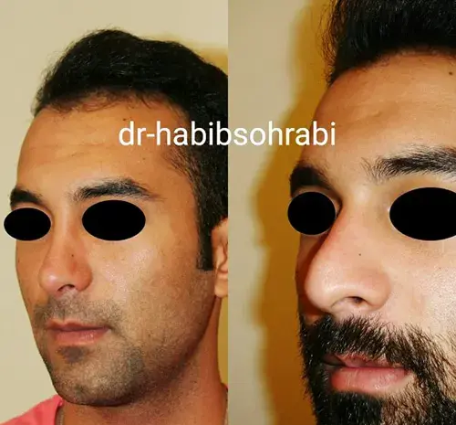 عکس قبل و بعد عمل بینی مردانه
