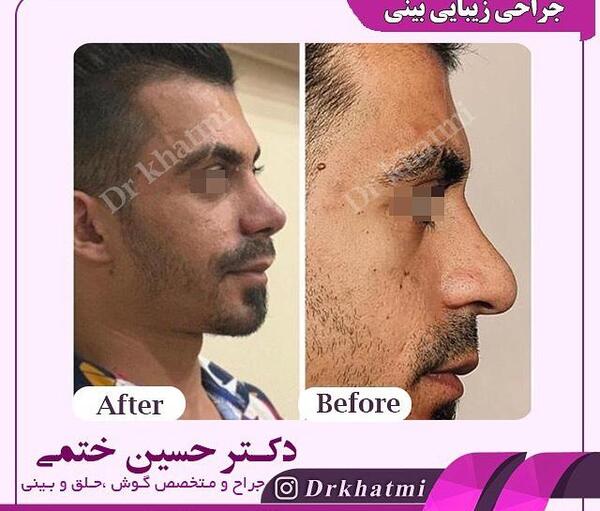 عکس قبل و بعد عمل بینی مردانه