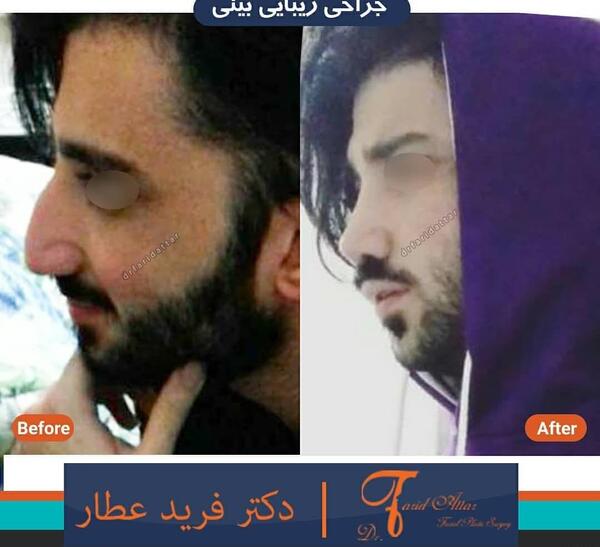 عکس قبل و بعد عمل بینی مردانه