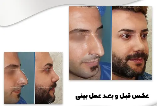 عکس قبل و بعد عمل بینی مردانه