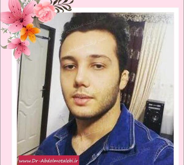 عکس قبل و بعد عمل بینی مردانه