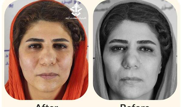 عکس قبل و بعد لیفت ابرو با نخ
