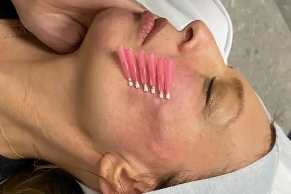 عکس قبل و بعد لیفت ابرو با نخ