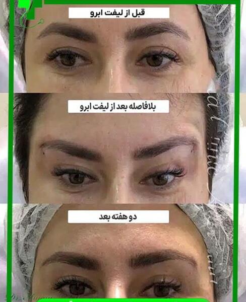 عکس قبل و بعد لیفت ابرو با نخ