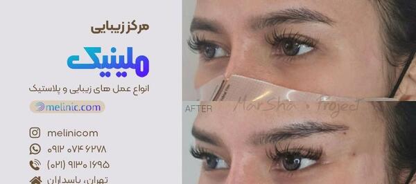 عکس قبل و بعد لیفت ابرو با نخ