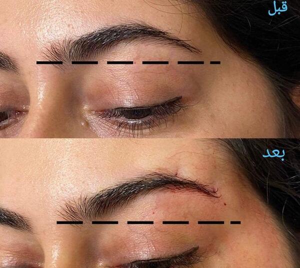 عکس قبل و بعد لیفت ابرو با نخ
