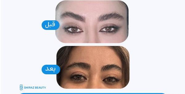 عکس قبل و بعد لیفت ابرو با نخ