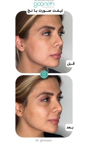 عکس قبل و بعد لیفت ابرو با نخ