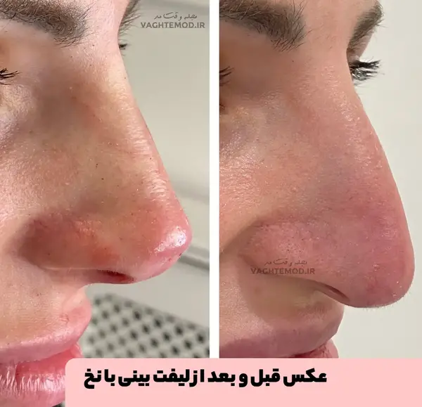 عکس قبل و بعد لیفت ابرو با نخ