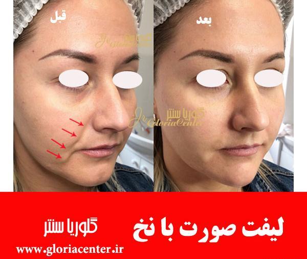 عکس قبل و بعد لیفت ابرو با نخ